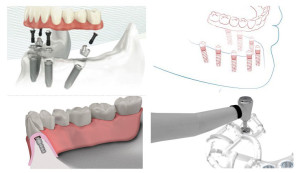 Full arch fixed denture Brisbane