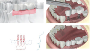 Multiple tooth replacement implants