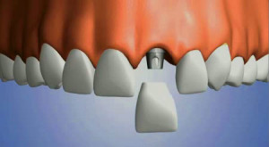 what is a dental implant crown